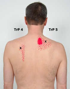 Trapezius - Pain Relief with Trigger Point Self-Help